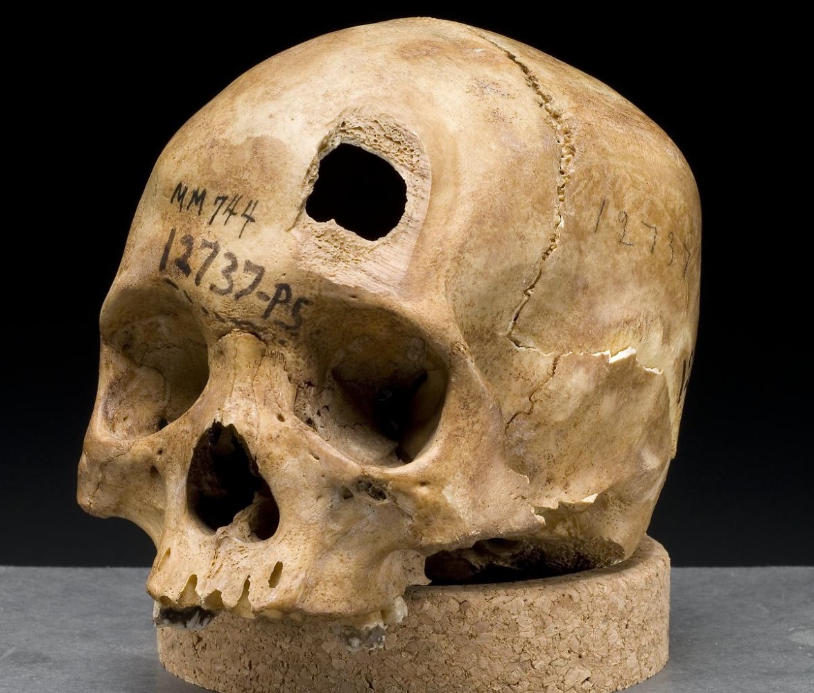 A human skull wiht a hole in the forehead.